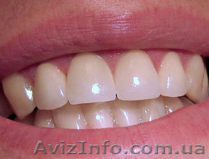 Лечение зубов (кариес,  пародонтоз),  протезирование,  отбеливание (центр Харькова) #92451