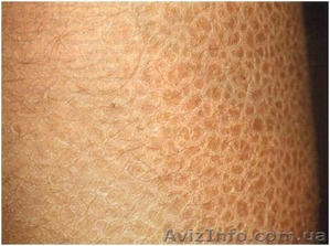 Средство от ихтиоза  #182664