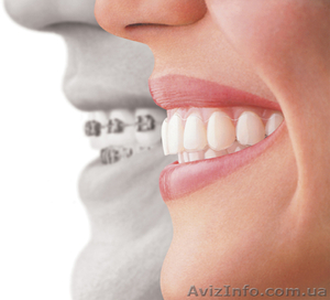 Врач-отродонт исправит неправильный прикус (Брекеты) #164678