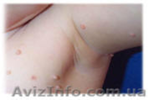 Видалення папілом,  пігментних неусів  #263944