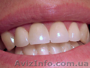 Лечение зубного камня,  кариеса (Харьков) #428355