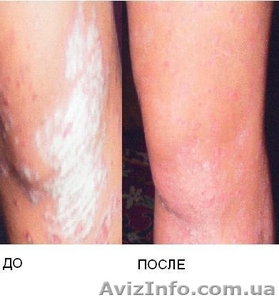 Лечение псориаза,  витилиго,  ожирения !!! #522515