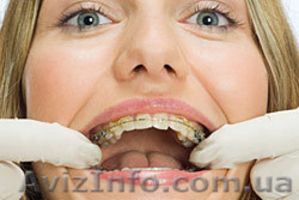 Исправление прикуса (брекеты) — Харьков #562390