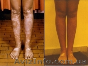 Средство от витилиго #651388