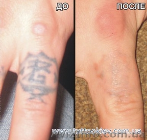Удаление татуировки Киев фото до и после,  вывести тату и татуаж Киев,   #724821
