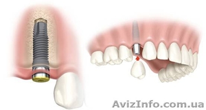 Установка имплантата! #747284