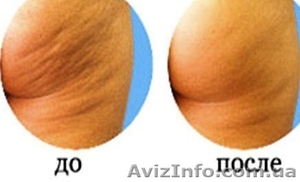 Вакуумный аппаратный антицеллюлитный массаж с выездом к Вам домой #812257