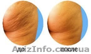 Курс антицеллюлитного массажа #832755