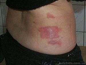 Мепиформ Самоклеящаяся силиконовая повязка для ухода за рубцами! #830888