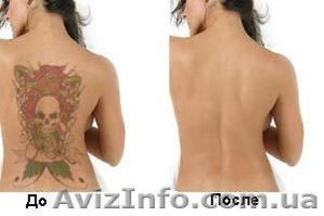 Лазерное удаление татуировок без следов и шрамов. #870646