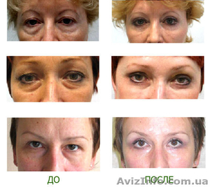 Блефаропластика (пластика верхнего и нижнего века) #858121