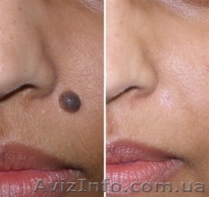 Процедуры коагулятора от Салона красоты