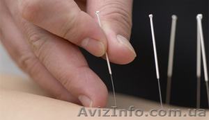 Иглоукалывание на дому в Киеве,  корейский специалист #892791
