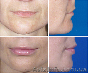 Липофилинг (Увлечение объемов лица и тела,  собственными жировыми клетками) #932147