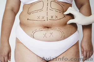 Липосакция в клинике Златадерма #932145