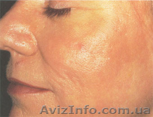 Лазерная шлифовка в клинике Златадерма #932130