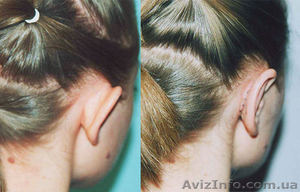 Отопластика (пластика ушей)  - клиника Златадерма #932142