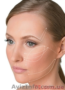 Подтяжка кожи нитями Aptos в клинике ЗлатаДерма #932134