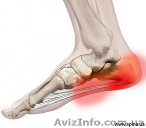 Пяточная шпора. Лечение и профилактика #957220