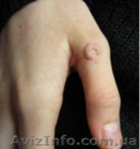 Удаление новообразований #1101350