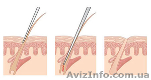Электроэпиляция #1169820