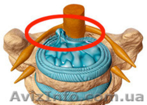 Лечение межпозвоночной грыжи без операции #1177286