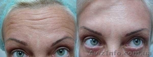 Инъекции Диспорт, ботокс #1205121