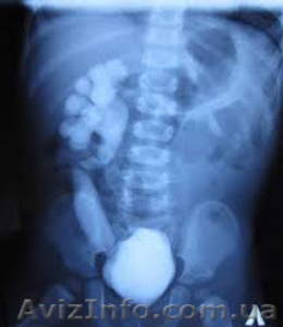 Микционная цистография взрослым и детям #1208763