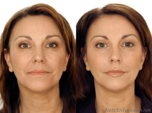 увеличение губ без инъекций,  чистка лица,  электрополяция #1268320