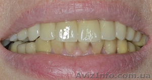 Имплантация при полной потере зубов #1276285