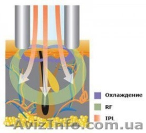 ЭЛОС эпиляция в Нежине #1376830