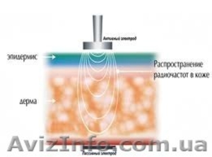 Радиочастотный лифтинг кожи (омоложение) #1376832
