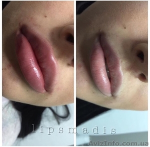 Увеличение,  коррекция губ  #1632127