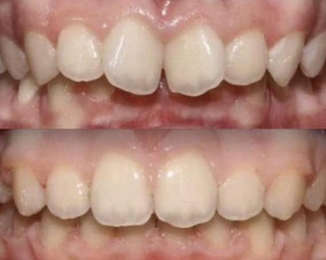 Брекети,  елайнери,  ортодонт Львів #1738536